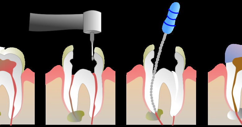 Warning Signs of Infection After a Root Canal