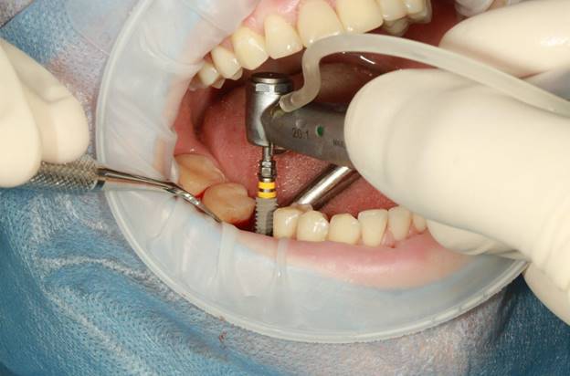 Tooth Roots