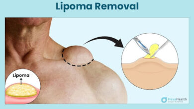 Understanding Lipoma Removal in London: A Complete Guide