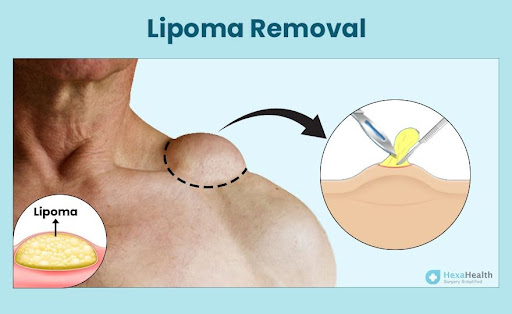 Understanding Lipoma Removal in London: A Complete Guide